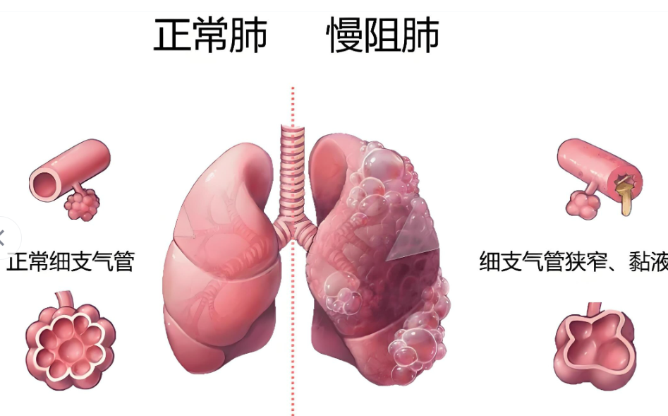慢性阻塞性肺疾病